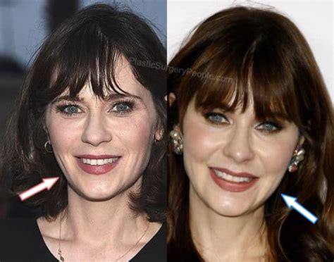 Zooey Deschanel Plastic Surgery Before & After